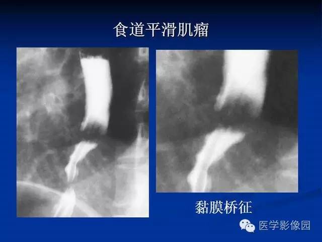 【PPT】食道疾病影像学