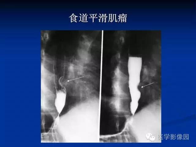 【PPT】食道疾病影像学