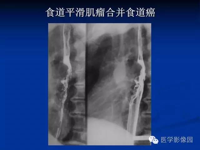 【PPT】食道疾病影像学