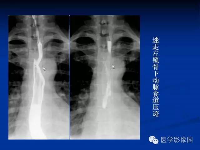 【PPT】食道疾病影像学