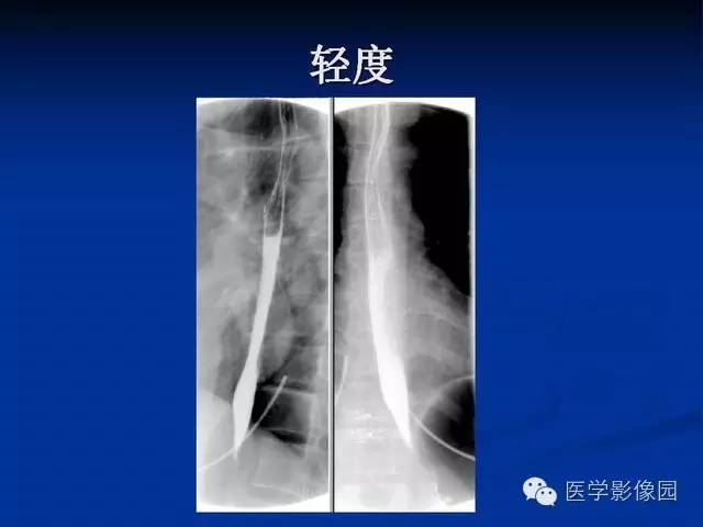 【PPT】食道疾病影像学