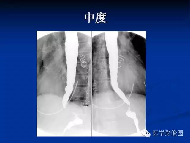 【PPT】食道疾病影像学