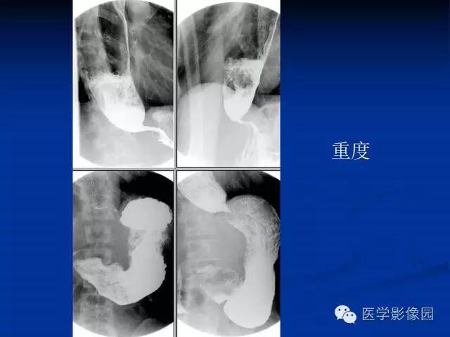 【PPT】食道疾病影像学