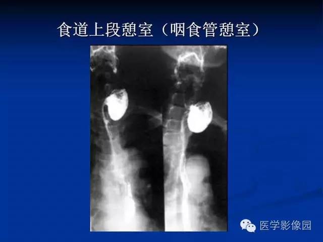 【PPT】食道疾病影像学