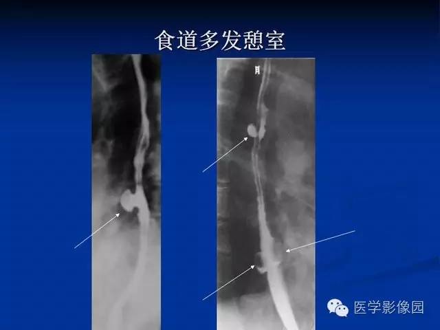 【PPT】食道疾病影像学