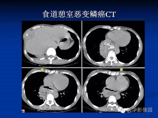 【PPT】食道疾病影像学