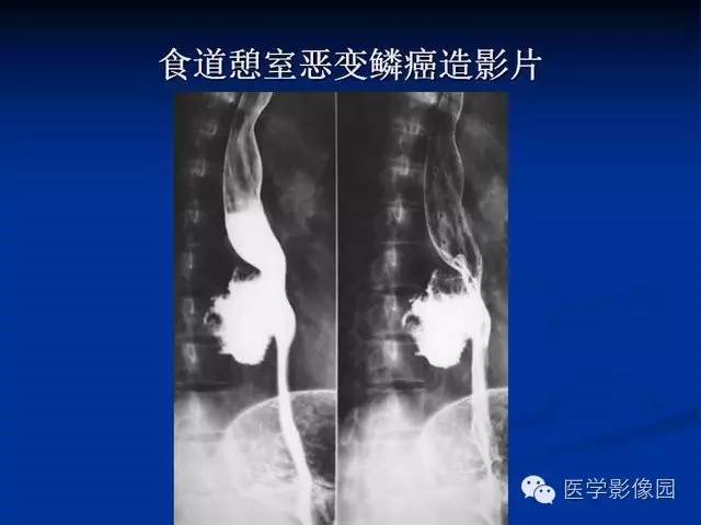 【PPT】食道疾病影像学