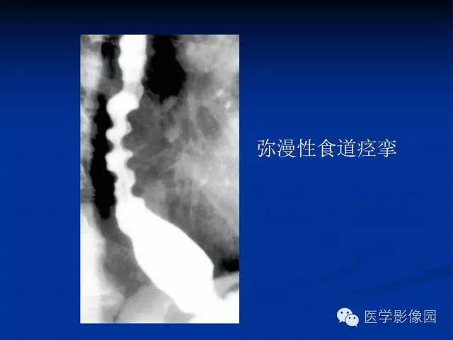 【PPT】食道疾病影像学
