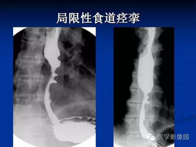 【PPT】食道疾病影像学