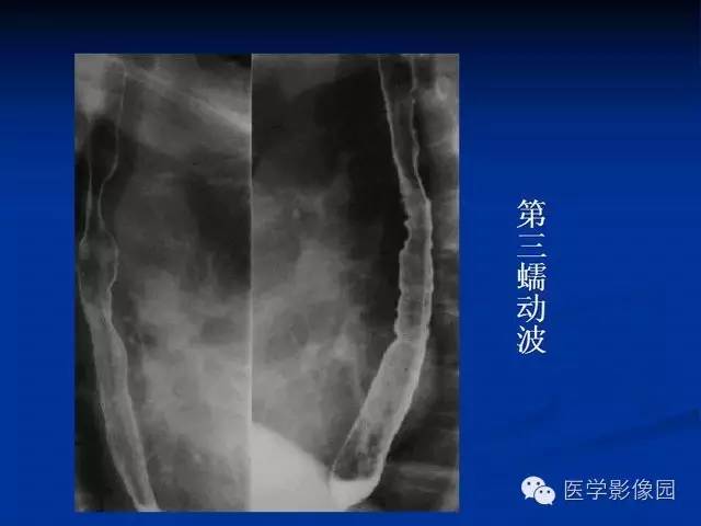 【PPT】食道疾病影像学