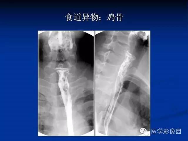 【PPT】食道疾病影像学