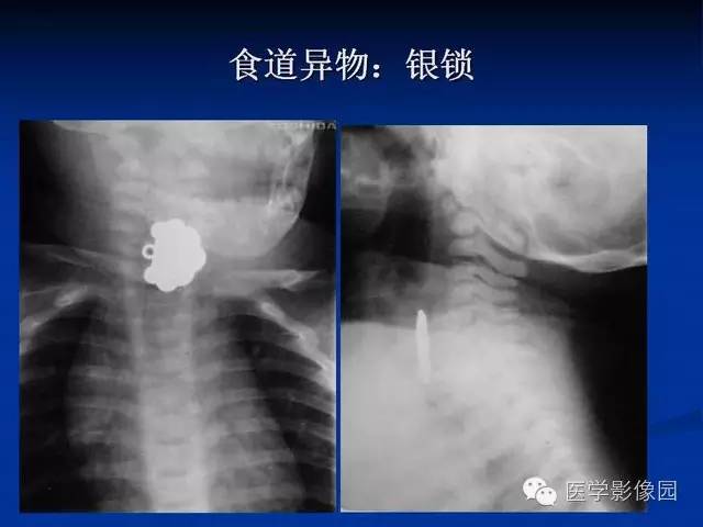 【PPT】食道疾病影像学