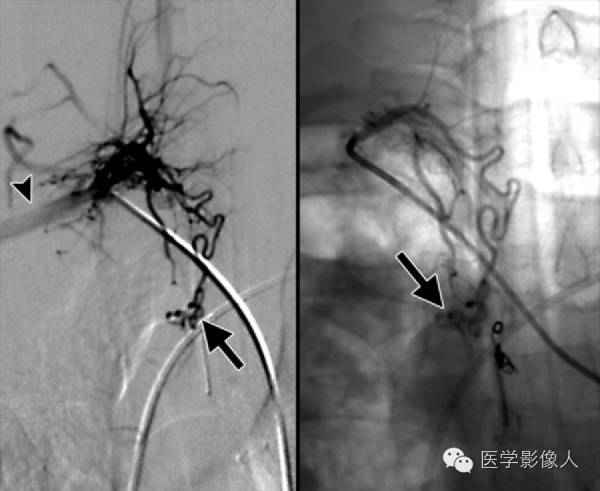 少见类型栓子脑梗死影像学表现