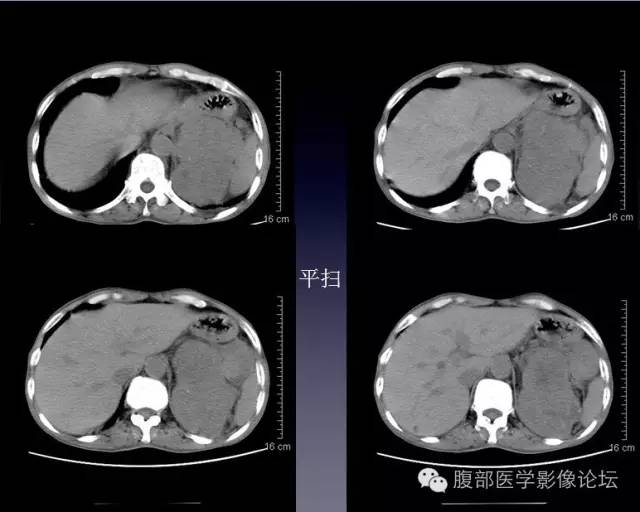 【病例】左侧肾上腺恶性纤维组织细胞瘤1例CT病例讨论