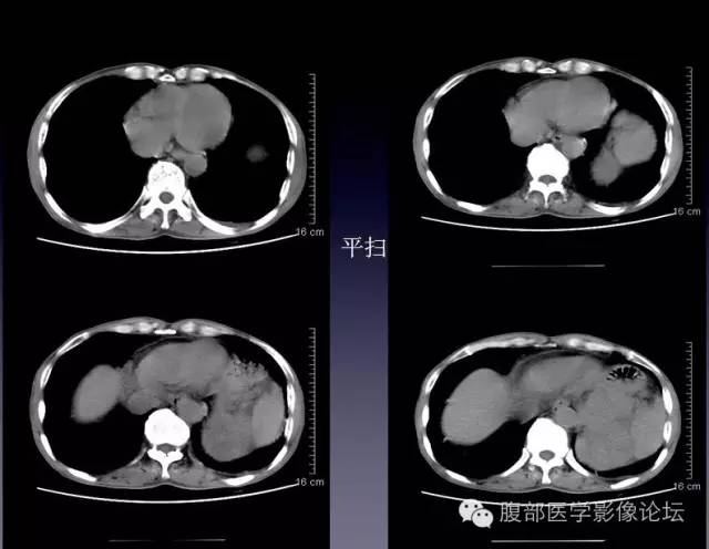【病例】左侧肾上腺恶性纤维组织细胞瘤1例CT病例讨论