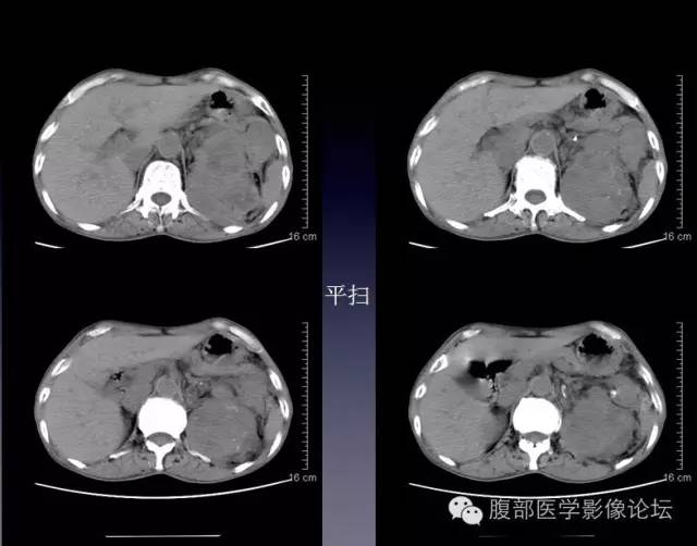 【病例】左侧肾上腺恶性纤维组织细胞瘤1例CT病例讨论