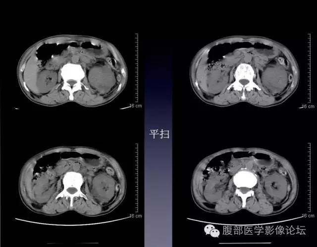 【病例】左侧肾上腺恶性纤维组织细胞瘤1例CT病例讨论