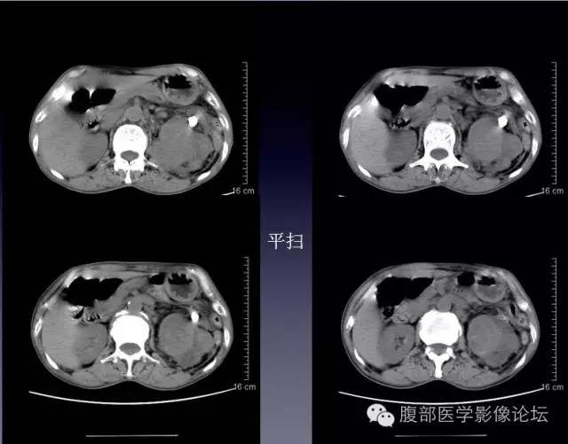 【病例】左侧肾上腺恶性纤维组织细胞瘤1例CT病例讨论