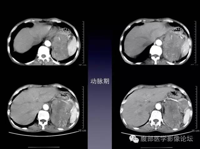 【病例】左侧肾上腺恶性纤维组织细胞瘤1例CT病例讨论