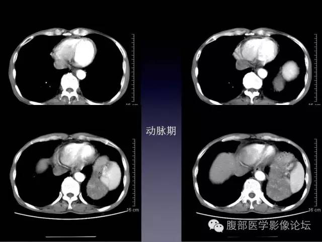 【病例】左侧肾上腺恶性纤维组织细胞瘤1例CT病例讨论