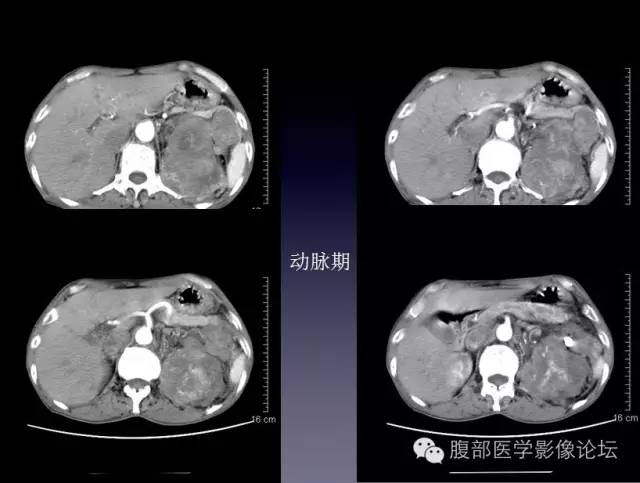 【病例】左侧肾上腺恶性纤维组织细胞瘤1例CT病例讨论