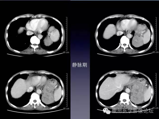 【病例】左侧肾上腺恶性纤维组织细胞瘤1例CT病例讨论