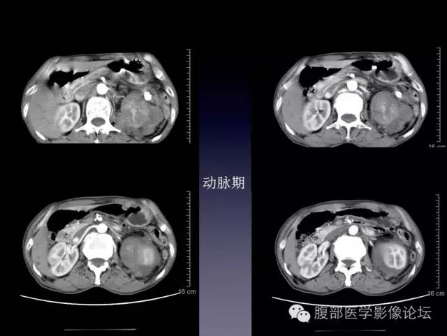 【病例】左侧肾上腺恶性纤维组织细胞瘤1例CT病例讨论