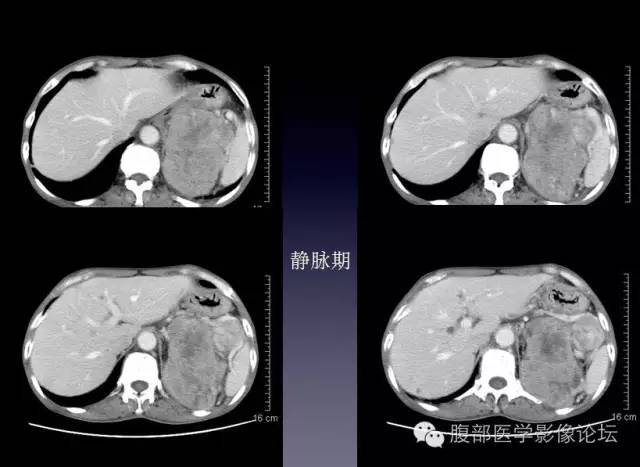 【病例】左侧肾上腺恶性纤维组织细胞瘤1例CT病例讨论