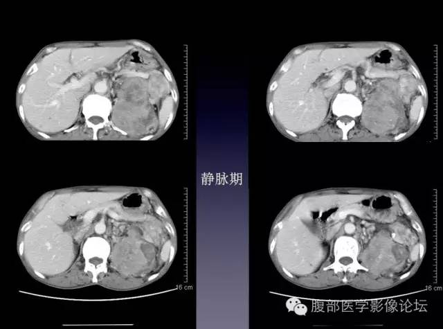 【病例】左侧肾上腺恶性纤维组织细胞瘤1例CT病例讨论