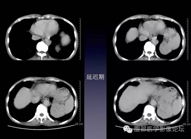 【病例】左侧肾上腺恶性纤维组织细胞瘤1例CT病例讨论