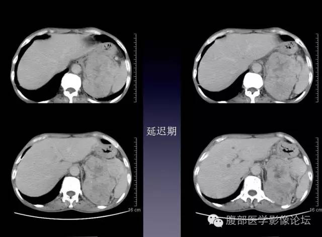【病例】左侧肾上腺恶性纤维组织细胞瘤1例CT病例讨论