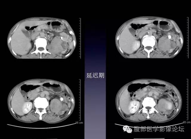 【病例】左侧肾上腺恶性纤维组织细胞瘤1例CT病例讨论