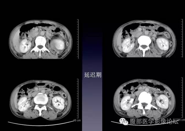 【病例】左侧肾上腺恶性纤维组织细胞瘤1例CT病例讨论