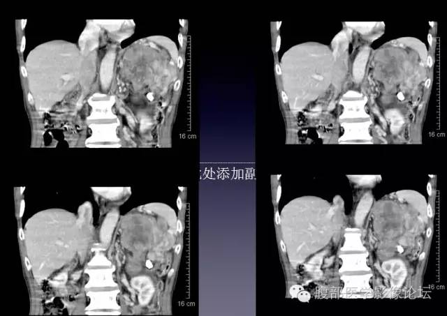 【病例】左侧肾上腺恶性纤维组织细胞瘤1例CT病例讨论