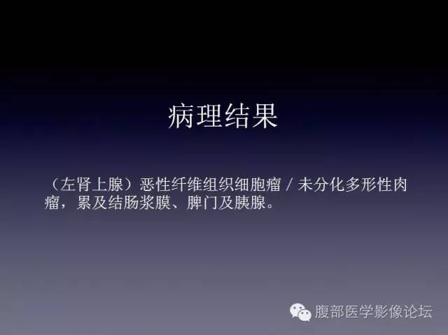 【病例】左侧肾上腺恶性纤维组织细胞瘤1例CT病例讨论