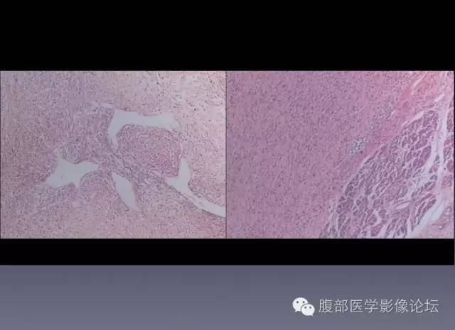 【病例】左侧肾上腺恶性纤维组织细胞瘤1例CT病例讨论