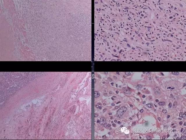 【病例】左侧肾上腺恶性纤维组织细胞瘤1例CT病例讨论