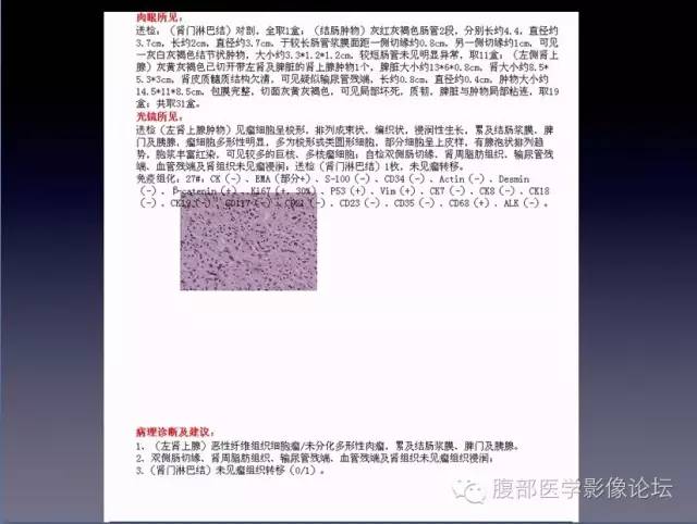 【病例】左侧肾上腺恶性纤维组织细胞瘤1例CT病例讨论