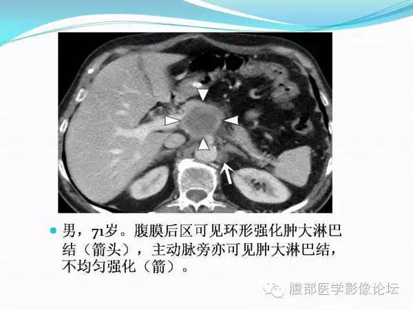 【PPT】腹部结核