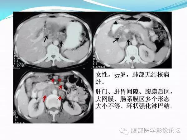 【PPT】腹部结核