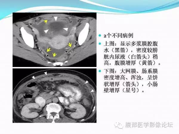 【PPT】腹部结核