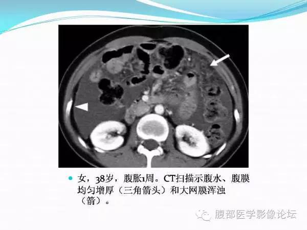 【PPT】腹部结核