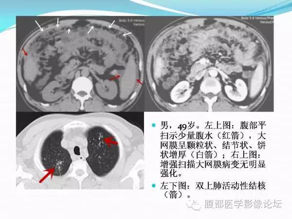 【PPT】腹部结核
