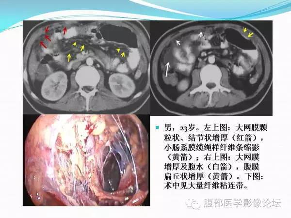 【PPT】腹部结核