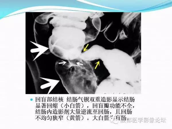 【PPT】腹部结核