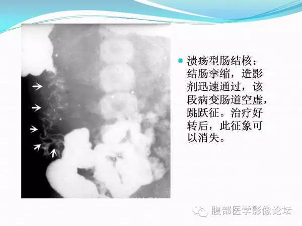 【PPT】腹部结核