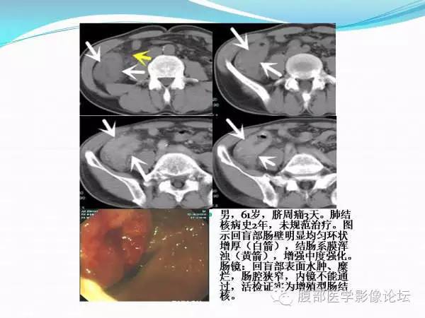 【PPT】腹部结核
