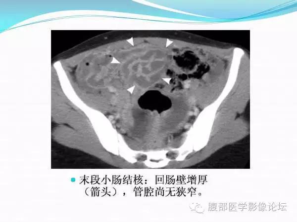 【PPT】腹部结核