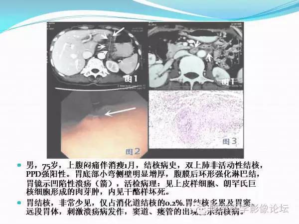 【PPT】腹部结核