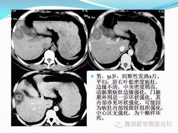 【PPT】腹部结核